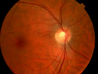 Normal retina right eye. The optic nerve is the pale disc on the right of the picture, the macular area is the darker indistinct area on the left side.