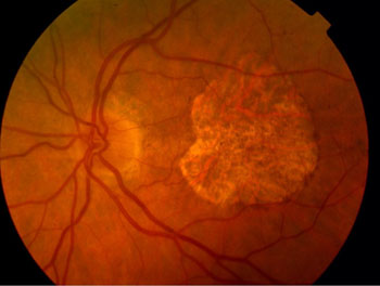 Severe dry AMD in the left eye, with a fairly large "punched out" area of retinal thinning to the right of the optic nerve.