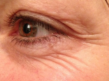 Laughter lines around left eye before treatment with Botox