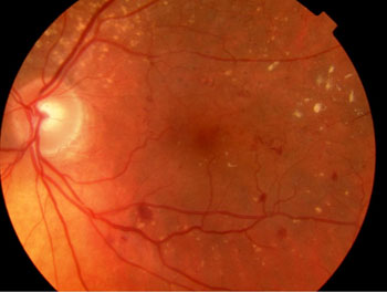 Marked background diabetic retinopathy left eye with several red haemorrhages and scattered pale exudates