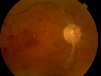 Proliferative diabetic retinopathy right eye with new blood vessels and pale scar tissue extending from the optic nerve above and below.