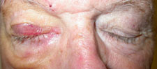 Same patient immediately after right brow lift and gold weight inserted into right upper lid