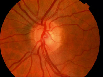 Normal optic nerve at the back of the eye. Relatively small pale area with centrally placed blood vessels.