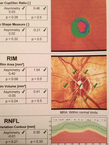 HRT 3 print out of a normal left optic nerve. In the top picture the healthy nerve tissue is coloured green surrounding the normal sized red "cup".