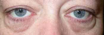 Tired looking eyes due to lower lid “eyebags” in a 41yr old lady