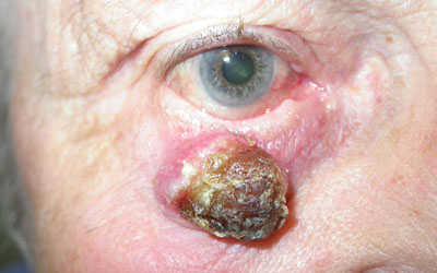 Rapidly growing squamous cell carcinoma