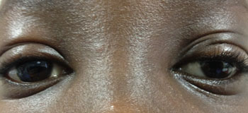Same patient 1 week following surgery to raise left upper lid using connective tissue from the left leg