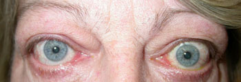 Typical appearance of thyroid eye disease with prominent eyes left>right