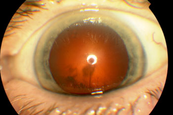 Dark cloudy patches in red reflex, especially in lower part of pupil