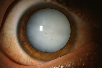 Dense white mature cataract completely blocking the red reflex